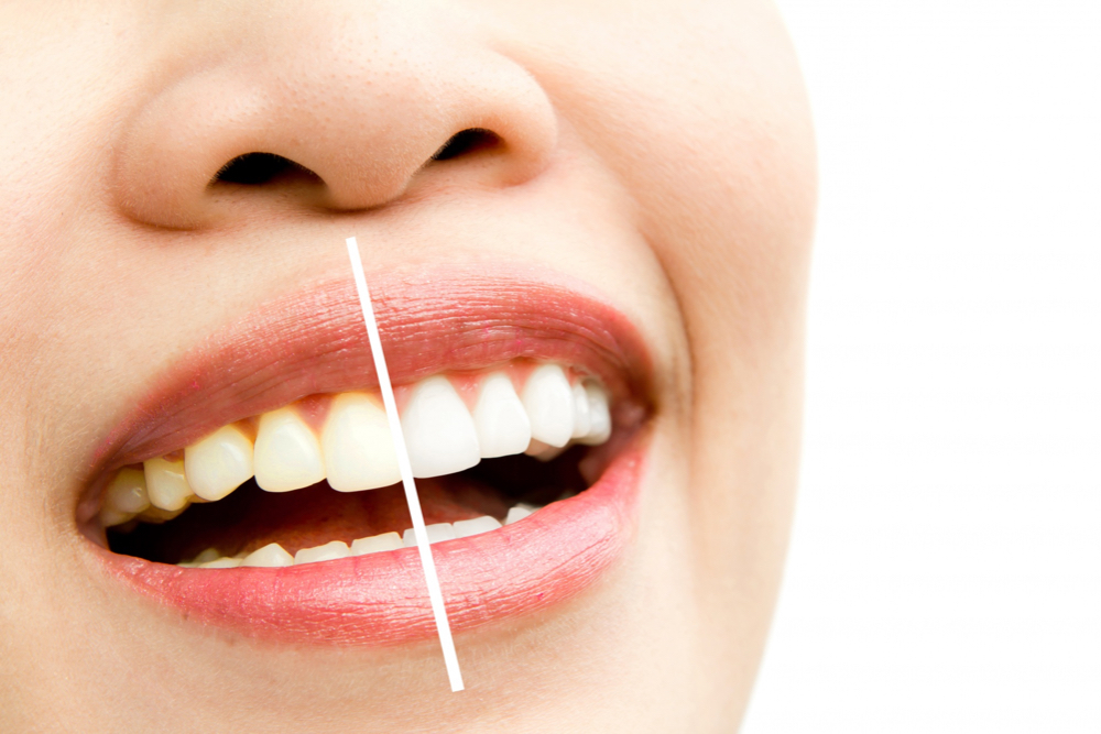 Lo que debes saber sobre el blanqueamiento dental