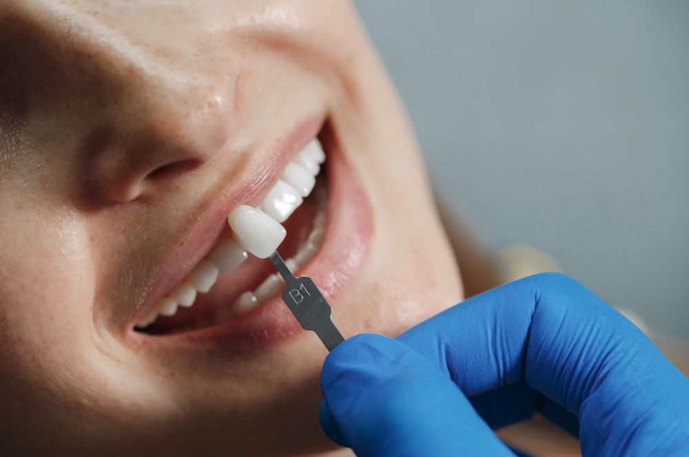 Lo que debes saber sobre las carillas dentales